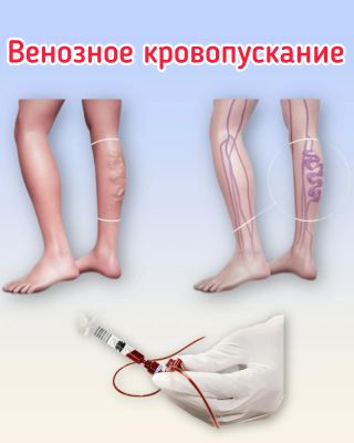 Венозное кровопускание при бессоннице — 10000 тг, 60 минут